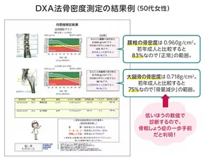 DXA法骨密度測定の結果例（50代女性）。腰椎と大腿骨の骨密度の測定結果。腰椎の骨密度は0.960g/㎠。 若年成人と比較すると83％なので「正常」の範囲。大腿骨の骨密度は0.718g/㎠。 若年成人と比較すると75％なので「骨量減少」の範囲。低いほうの数値で診断するので、骨粗しょう症の一歩手前。