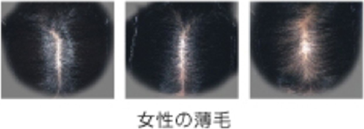 女性の薄毛 抜け毛 髪の知識 花王株式会社 ヘアケアサイト