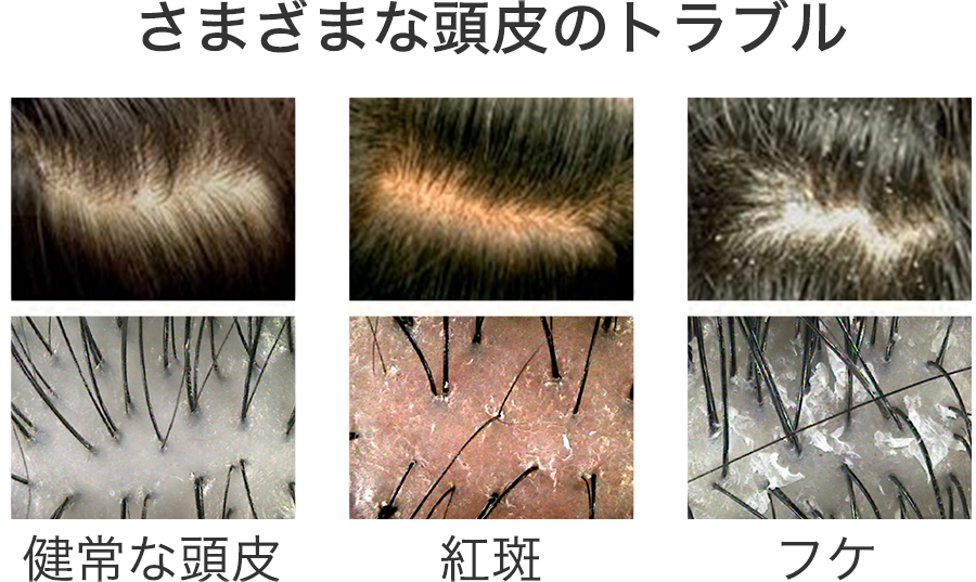 が 固い 頭皮 固い頭皮は薄毛・抜け毛の原因に！頭皮を柔らかくするマッサージとは