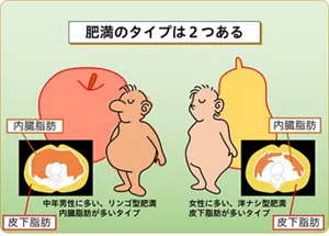図1　CTイメージや内臓脂肪型肥満と皮下脂肪型肥満を示した図。肥満には2つのタイプがあることを示しており、左側は内臓脂肪型肥満で、中年男性に多いリンゴ型体型。右側は皮下脂肪型肥満で、女性に多い洋ナシ型体型。