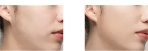 Before After
