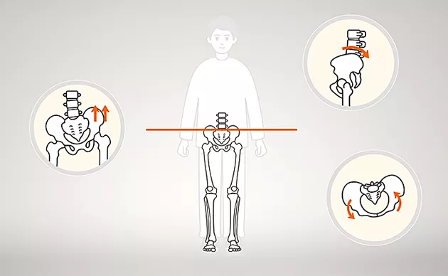 ゆがみのある足の骨の図