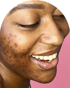 Biore_Oct_NormalizeAcne