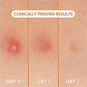 Desktop PDP - Spot Patches (600 x 600 px) - Spot Patches Before and After - Desktop