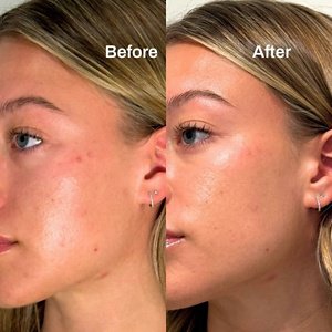 Desktop PDP - Liquid Spot Patches (600 x 600 px) - Spot Patch Before and After - Desktop