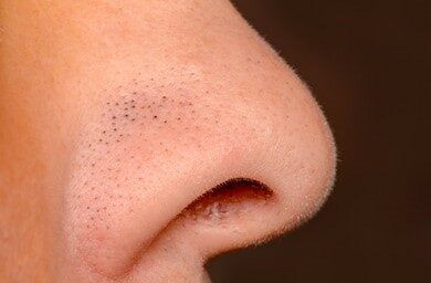 How to Get Rid of Blackheads on Your Nose for Good! | Bioré® Skincare