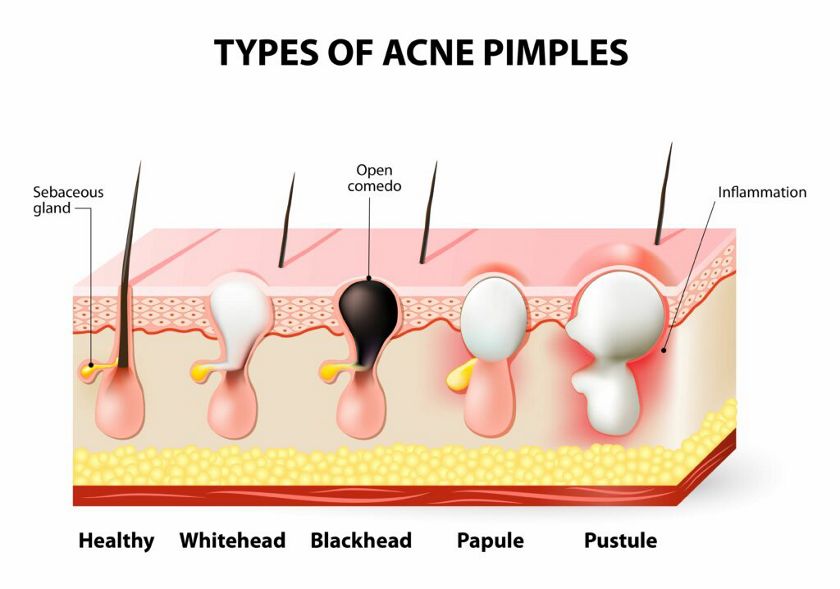 What Are Blackheads Biore Skincare Blog