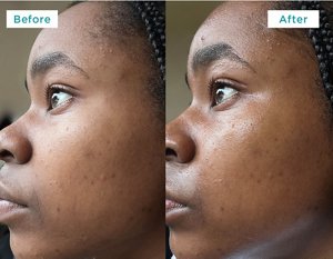 Images showing young woman's skin results before and after using Curél Deep Moisture Spray