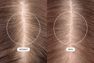 Bild zu Goldwell Dualsenses Scalp Specialist mit Salbei-Extrakt und Octiprox-Technologie, das brünettes Haar und die Kopfhaut zeigt, mit nebeneinander angeordneten kreisförmigen Überlagerungen zum Vergleich der Wirkung mit und ohne Kopfhautpflege.