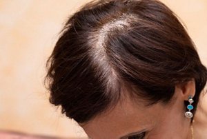 A woman's scalp showing signs of hair loss