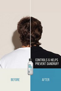 kmshair_PP_PDP_desktop_HR-AntiDandruff-BeforeAfter